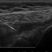 Advanced Needle Visualization In Action